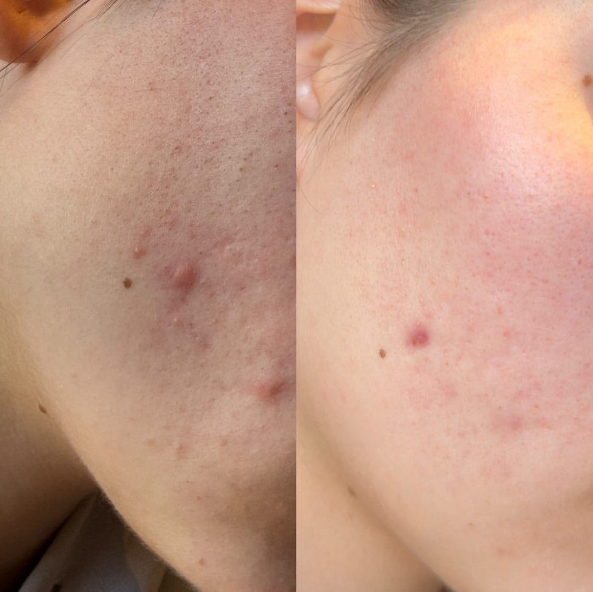 Before and after image showing visible improvement of acne-prone skin on a woman's lower face after treatment. The top photo shows inflamed breakouts, while the bottom photo reveals calmer, clearer skin with reduced redness and blemishes.