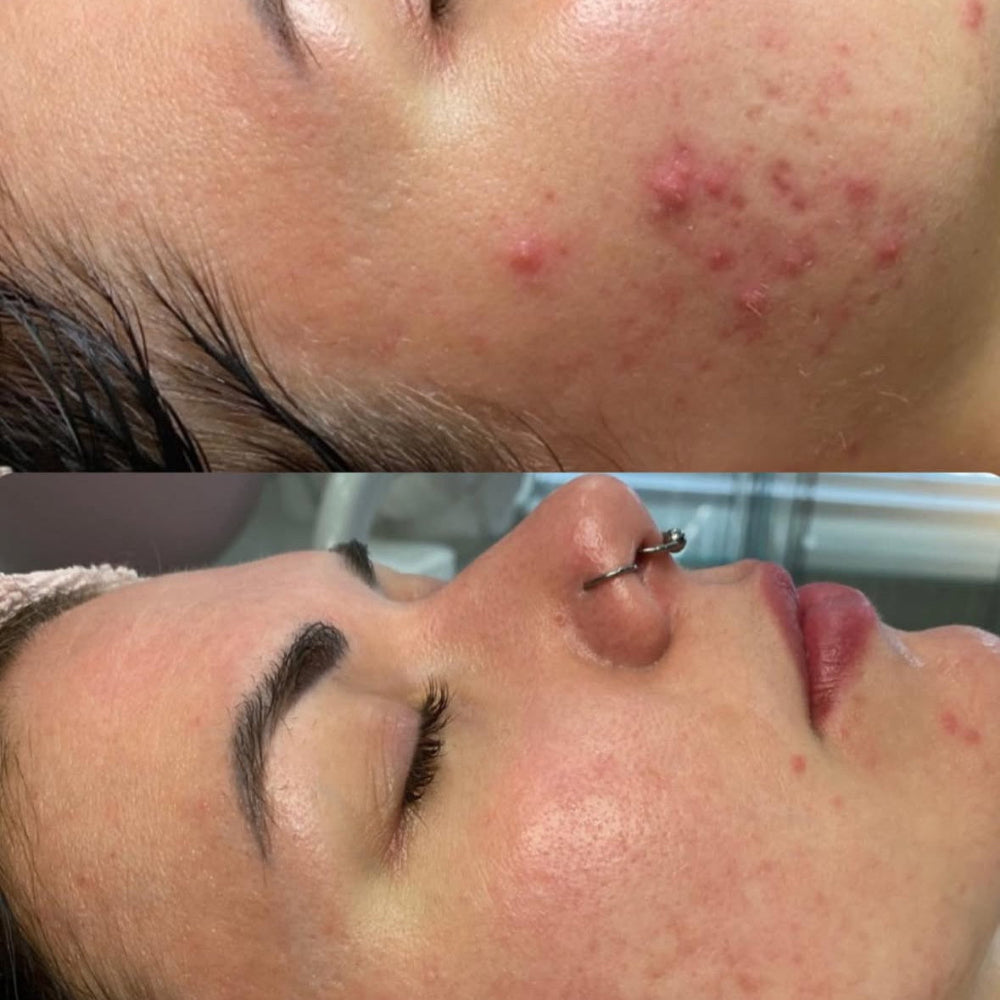 Before and after image showing visible improvement of acne-prone skin on a woman's lower face after treatment. The top photo shows inflamed breakouts, while the bottom photo reveals calmer, clearer skin with reduced redness and blemishes.