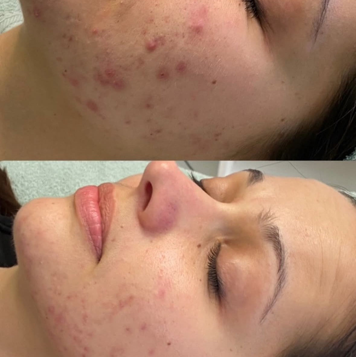 Before and after image showing visible improvement of acne-prone skin on a woman's lower face after treatment. The top photo shows inflamed breakouts, while the bottom photo reveals calmer, clearer skin with reduced redness and blemishes.