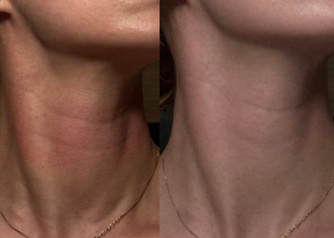 dermastamp uporaba na lasišču za nego in stimulacijo